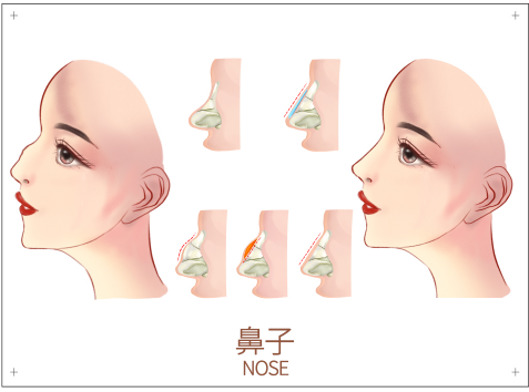 硅胶假体植入隆鼻是什么 硅胶假体隆鼻可以维持多久