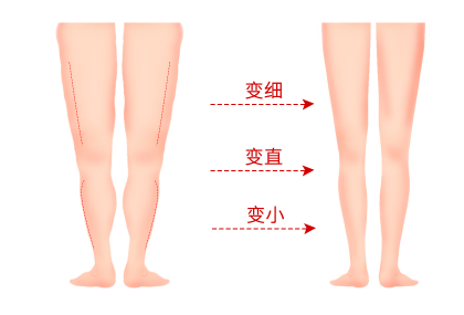 当下吸脂整形方法有哪些 小腿共振吸脂减肥有哪些注意事项 